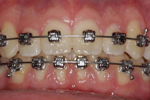 Clinicas-Dentales-Grupo-Nefa-ortodoncia-2