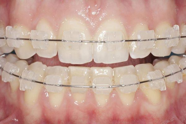 Clinicas-Dentales-Grupo-Nefa-ortodoncia-4